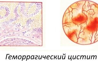 Лечение Геморрагического цистита