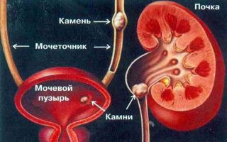 Признаки мочекаменной болезни